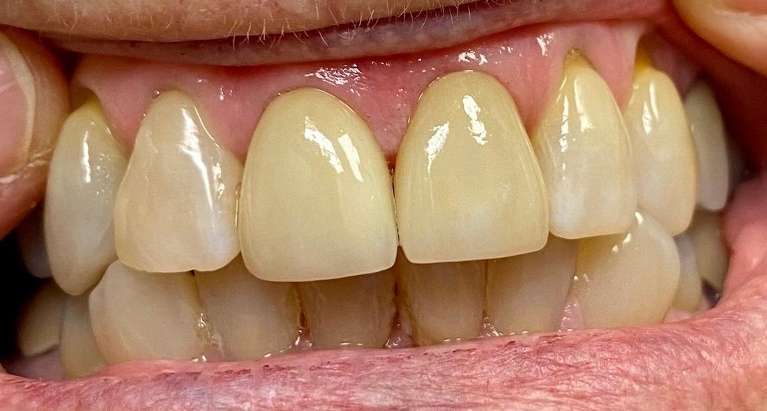 Porcelain-Veneers-After-Image