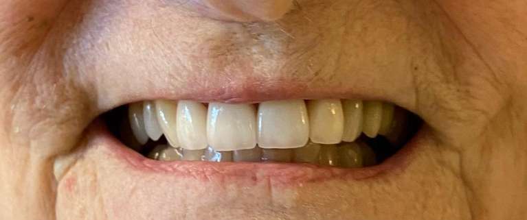 Dental-Crowns-After-Image