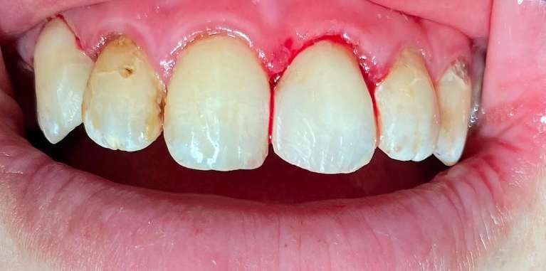 Composite-Tooth-Fillings-After-Image