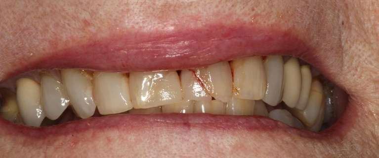 Dental-Crowns-Before-Image
