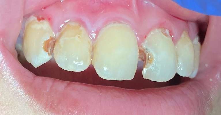 Composite-Tooth-Fillings-Before-Image